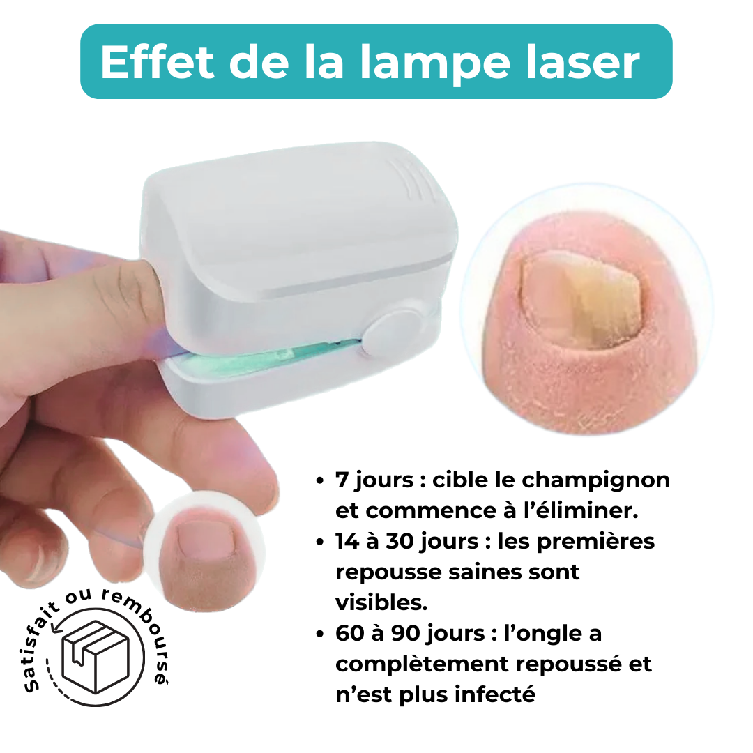 Lampe Laser - Mycose des ongles